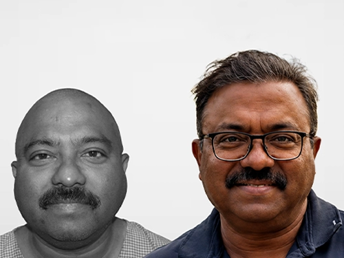 Hair transplant result – 9,692 grafts, Grade 6 baldness, Delhi patient