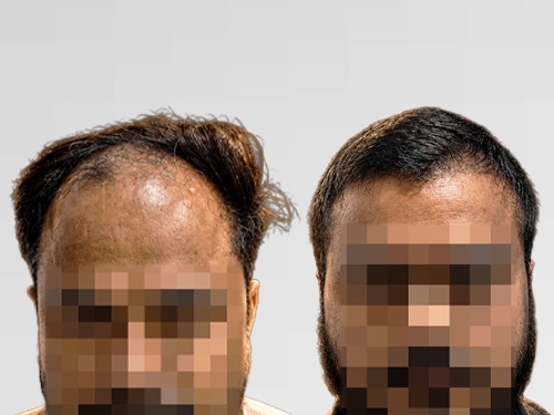 Full scalp hair transplant result – 3,300 grafts, Bengaluru patient