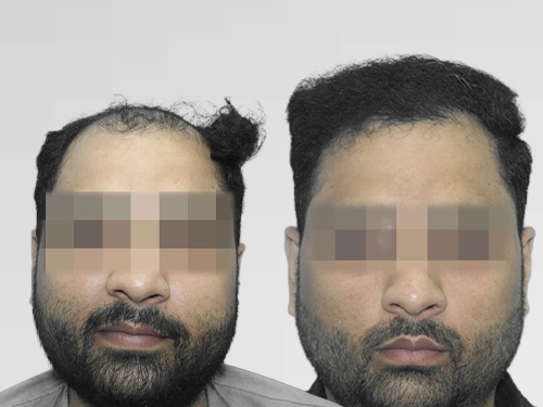 Frontal hairline restoration – 2,200 grafts, Ludhiana patient