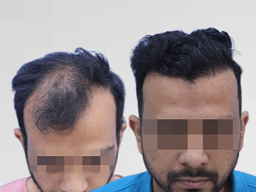 Hairline and mid-scalp hair transplant – 3,200 grafts, Ludhiana