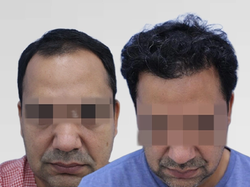 Frontal and temple hair transplant – 2,200 grafts, Bengaluru